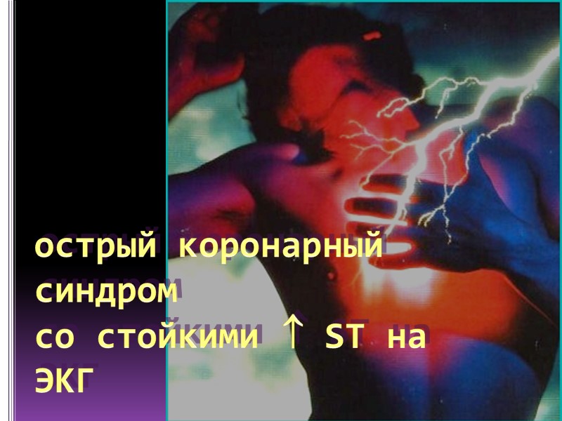 острый коронарный синдром  со стойкими  ST на ЭКГ